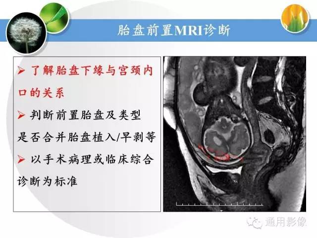 【PPT】异常妊娠的MRI表现