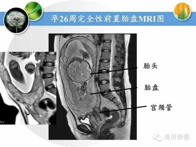 【PPT】异常妊娠的MRI表现