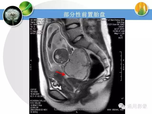 【PPT】异常妊娠的MRI表现