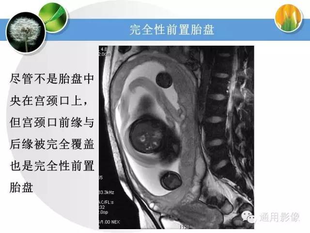 【PPT】异常妊娠的MRI表现