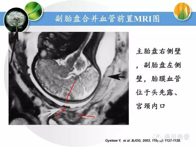【PPT】异常妊娠的MRI表现