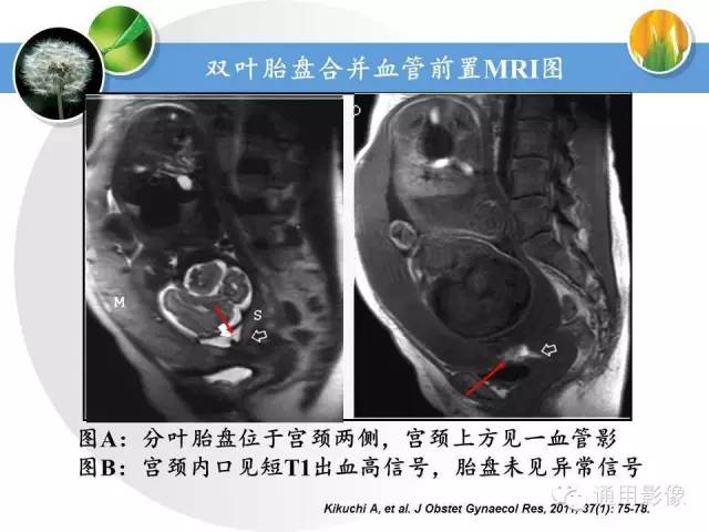 【PPT】异常妊娠的MRI表现