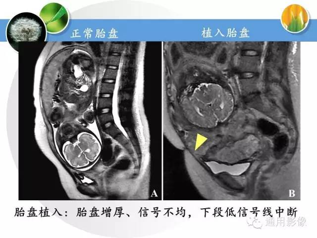 【PPT】异常妊娠的MRI表现