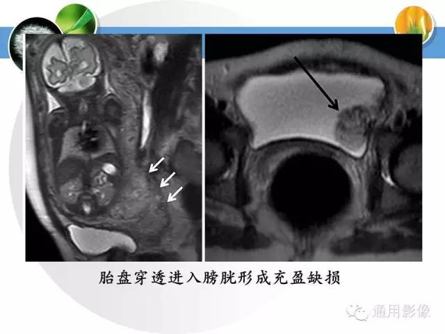 【PPT】异常妊娠的MRI表现