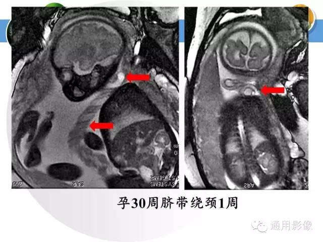 【PPT】异常妊娠的MRI表现
