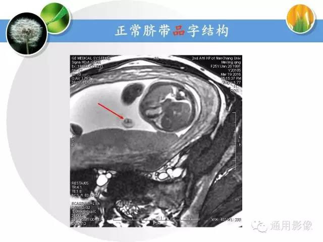 【PPT】异常妊娠的MRI表现