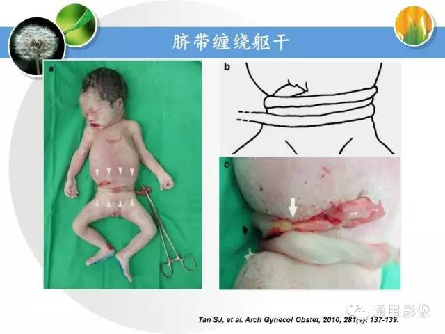 【PPT】异常妊娠的MRI表现