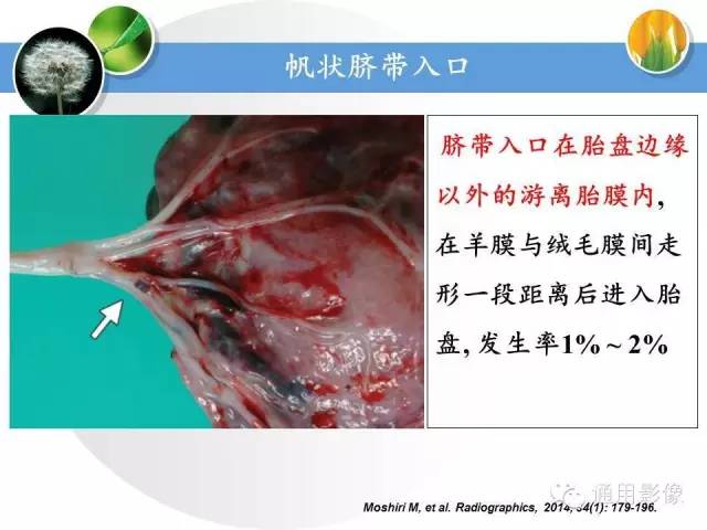 【PPT】异常妊娠的MRI表现