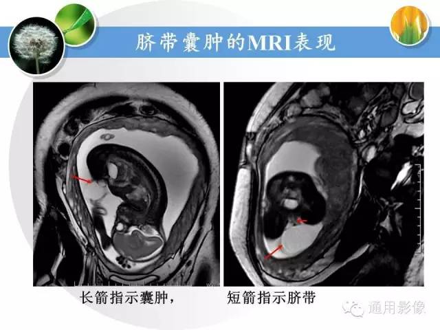 【PPT】异常妊娠的MRI表现