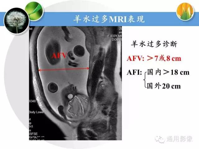 【PPT】异常妊娠的MRI表现