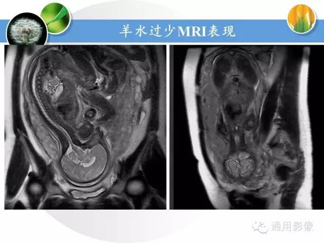 【PPT】异常妊娠的MRI表现