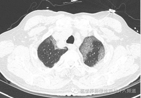 【病例】百草枯中毒1例肺部CT影像表现