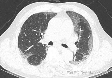 【病例】百草枯中毒1例肺部CT影像表现