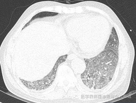 【病例】百草枯中毒1例肺部CT影像表现