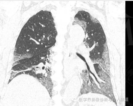【病例】百草枯中毒1例肺部CT影像表现