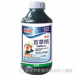 【病例】百草枯中毒1例肺部CT影像表现