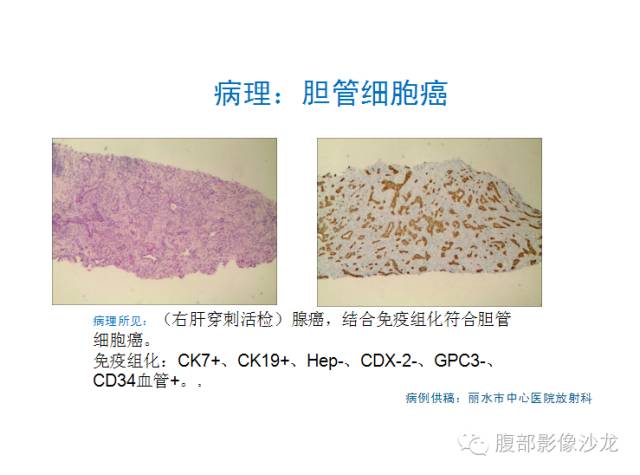 【病例】肝内胆管细胞癌1例CT及MR影像表现 【病例】肝内胆管细胞癌1例CT及MR影像表现