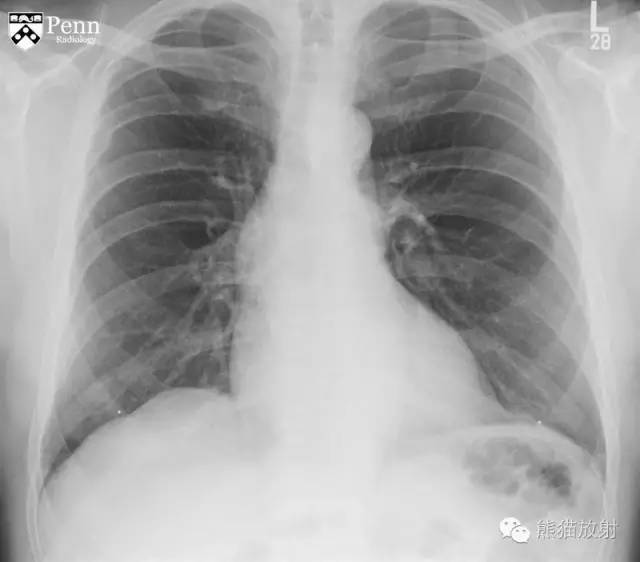 【双语病例】胸腺囊肿1例