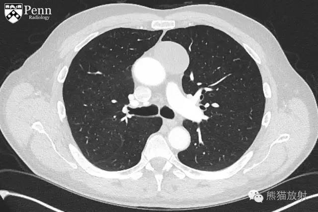 【双语病例】胸腺囊肿1例
