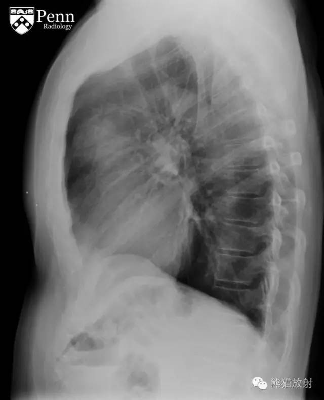 【双语病例】胸腺囊肿1例