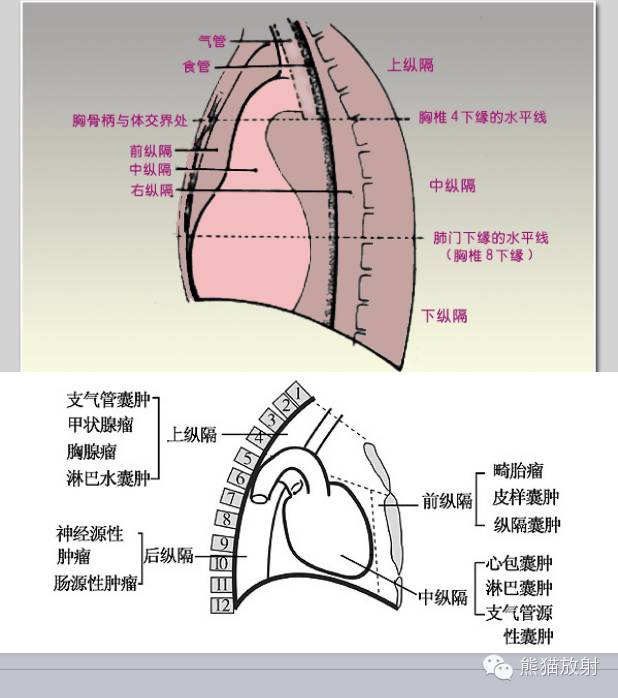 【双语病例】胸腺囊肿1例