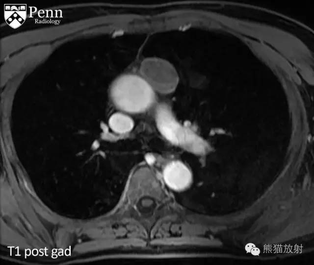 【双语病例】胸腺囊肿1例