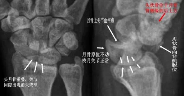 腕关节脱位及X线阅片技巧 腕关节脱位及X线阅片技巧