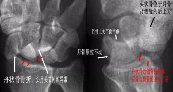 腕关节脱位及X线阅片技巧 腕关节脱位及X线阅片技巧