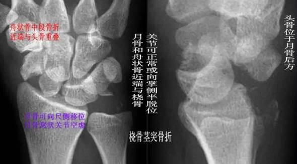 腕关节脱位及X线阅片技巧 腕关节脱位及X线阅片技巧