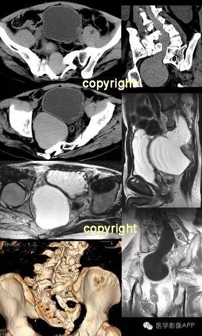 【病例】骶椎裂伴脊膜膨出1例CT及MR影像表现