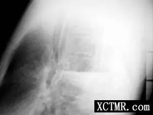 【病例】肺囊肿合并感染1例X线影像表现