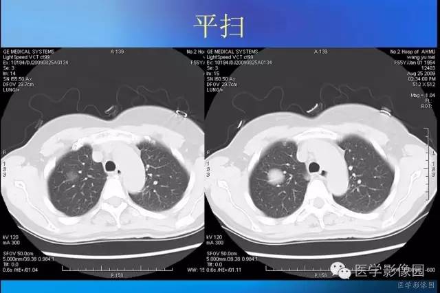 【病例】肺硬化性血管瘤1例CT影像表现