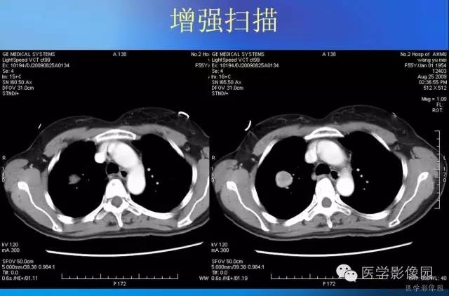 【病例】肺硬化性血管瘤1例CT影像表现 【病例】肺硬化性血管瘤1例CT影像表现