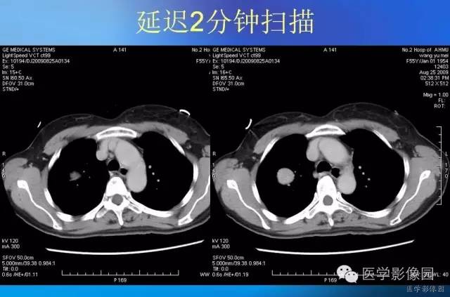 【病例】肺硬化性血管瘤1例CT影像表现 【病例】肺硬化性血管瘤1例CT影像表现