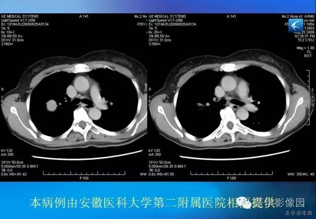 【病例】肺硬化性血管瘤1例CT影像表现 【病例】肺硬化性血管瘤1例CT影像表现