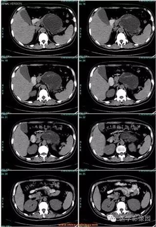【病例】胰腺浆液性囊腺瘤1例CT影像表现