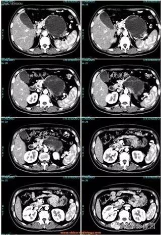 【病例】胰腺浆液性囊腺瘤1例CT影像表现