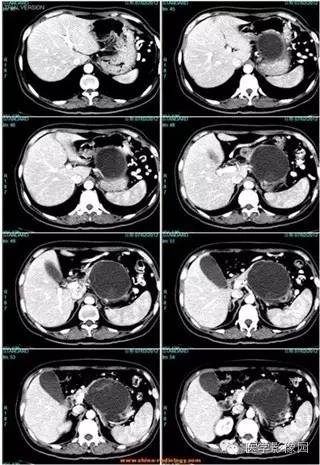 【病例】胰腺浆液性囊腺瘤1例CT影像表现
