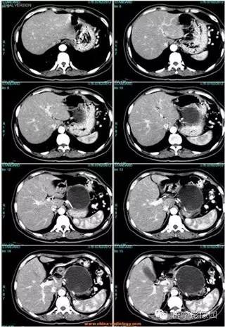【病例】胰腺浆液性囊腺瘤1例CT影像表现