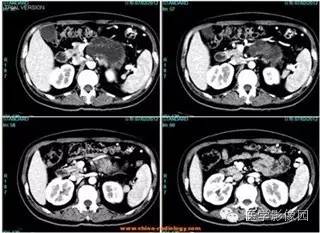 【病例】胰腺浆液性囊腺瘤1例CT影像表现