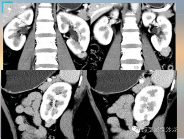 【病例】乏脂肪型血管平滑肌脂肪瘤1例 【病例】乏脂肪型血管平滑肌脂肪瘤1例