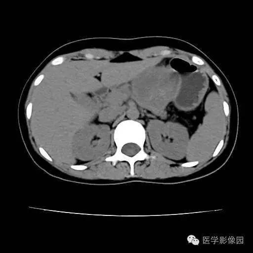 【病例】胰腺实性假乳头状瘤1例CT影像表现 【病例】胰腺实性假乳头状瘤1例CT影像表现