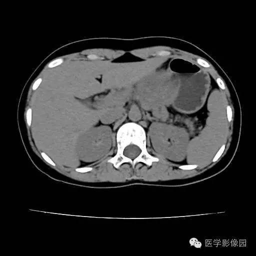 【病例】胰腺实性假乳头状瘤1例CT影像表现