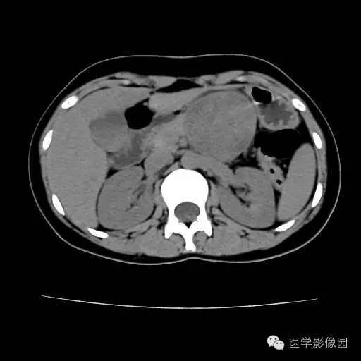 【病例】胰腺实性假乳头状瘤1例CT影像表现 【病例】胰腺实性假乳头状瘤1例CT影像表现