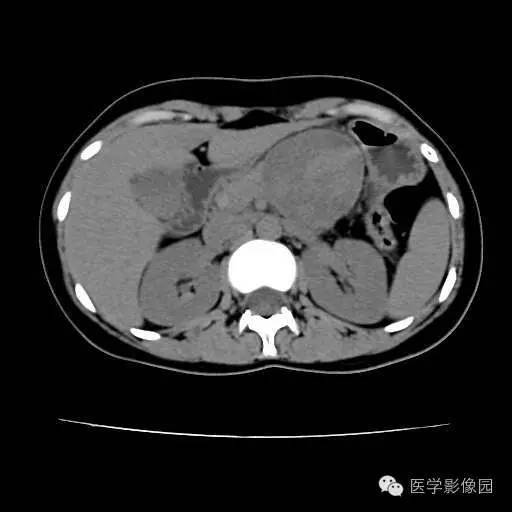 【病例】胰腺实性假乳头状瘤1例CT影像表现 【病例】胰腺实性假乳头状瘤1例CT影像表现