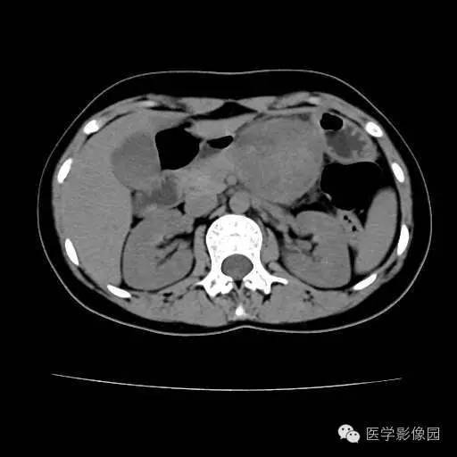 【病例】胰腺实性假乳头状瘤1例CT影像表现 【病例】胰腺实性假乳头状瘤1例CT影像表现