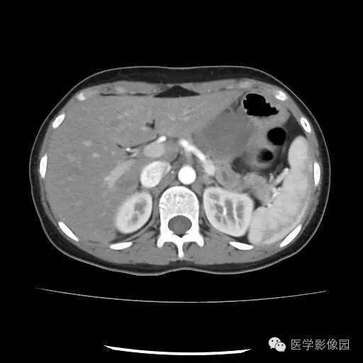 【病例】胰腺实性假乳头状瘤1例CT影像表现 【病例】胰腺实性假乳头状瘤1例CT影像表现
