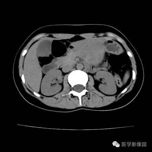 【病例】胰腺实性假乳头状瘤1例CT影像表现 【病例】胰腺实性假乳头状瘤1例CT影像表现