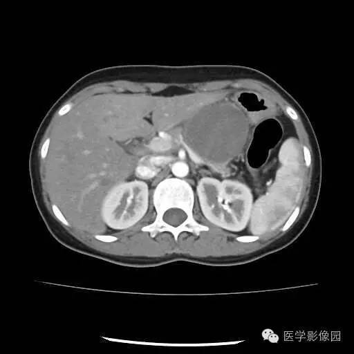【病例】胰腺实性假乳头状瘤1例CT影像表现 【病例】胰腺实性假乳头状瘤1例CT影像表现