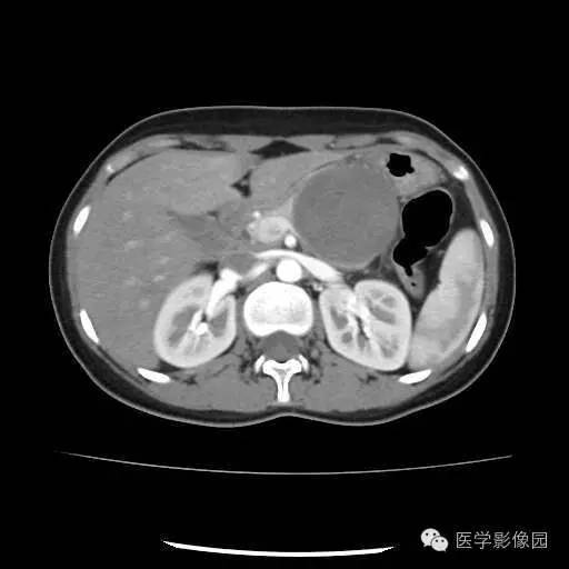 【病例】胰腺实性假乳头状瘤1例CT影像表现 【病例】胰腺实性假乳头状瘤1例CT影像表现